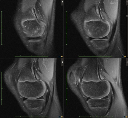 Figure 3 for case Cortical desmoid